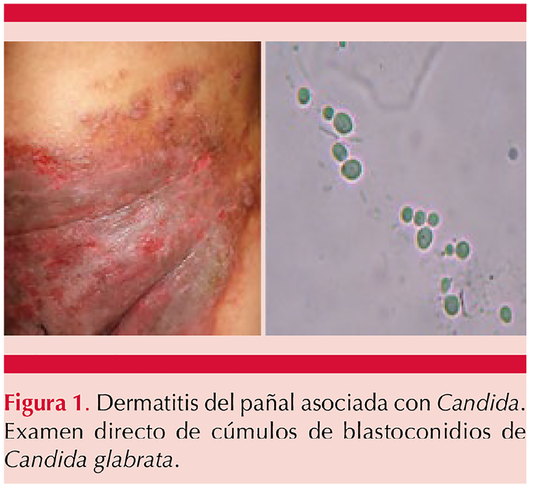 Qué tiene en común la dermatitis del en niños la de y ancianos? – Dermatología Revista