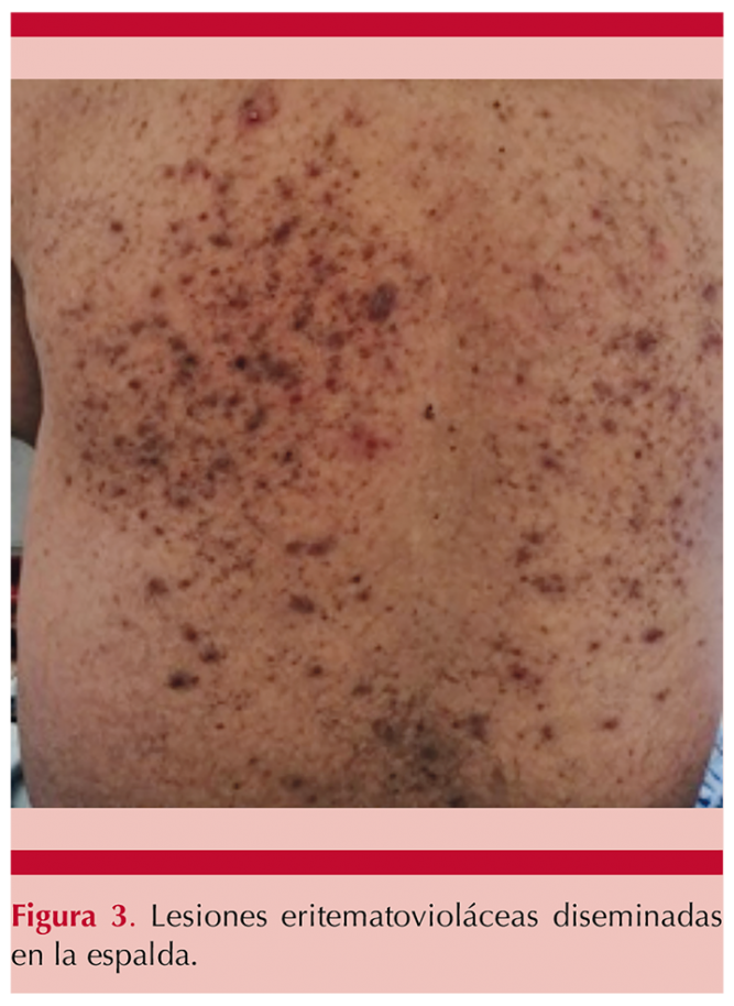 Síndrome de Bazex (acroqueratosis paraneoplásica) asociado con ...