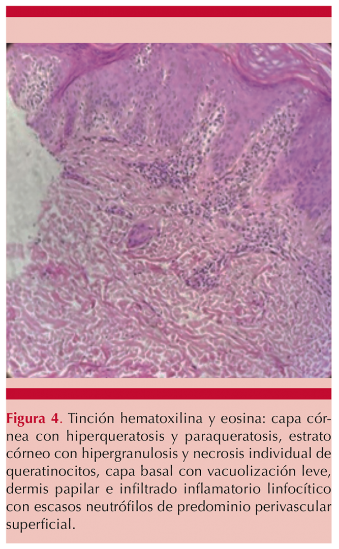 Síndrome de Bazex (acroqueratosis paraneoplásica) asociado con ...